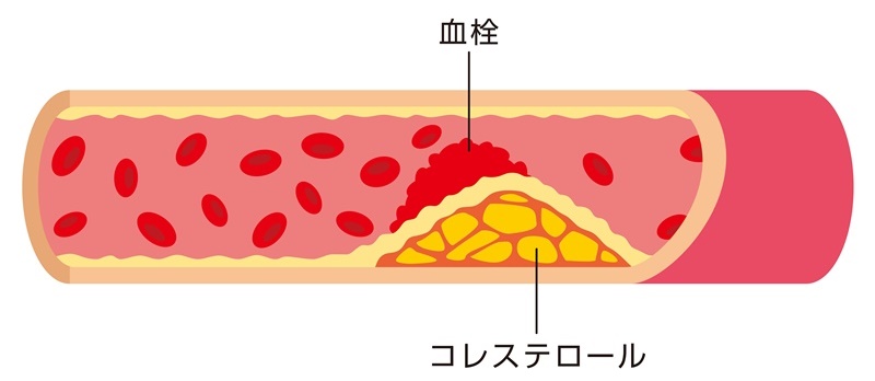 高血圧