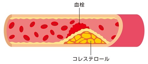 高血圧